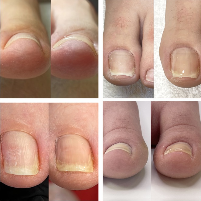 Representation for An innovative solution to the curved down nails