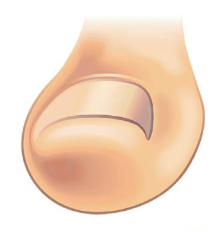 toenail painful
